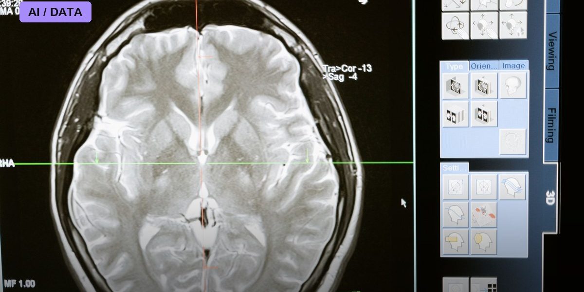 AI Reading Plain CT Scans Catches Stroke Blockages Doctors Miss, Multinational Trial Finds