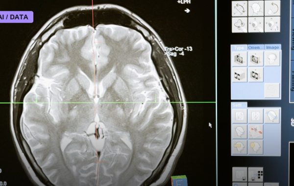 AI Reading Plain CT Scans Catches Stroke Blockages Doctors Miss, Multinational Trial Finds
