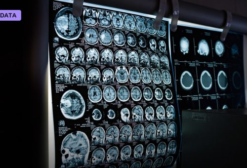 Nearly Half a Million Women in One Study Show What AI Actually Adds to Breast Cancer Screening