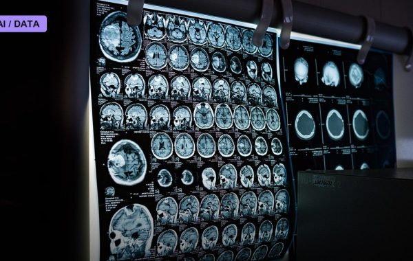 Nearly Half a Million Women in One Study Show What AI Actually Adds to Breast Cancer Screening