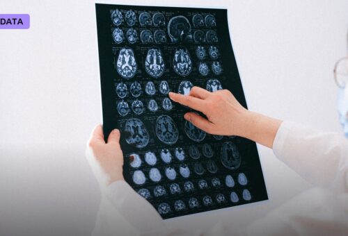 AI Cuts Stroke Diagnosis Time From an Hour to Two Minutes at Apollo Hospitals