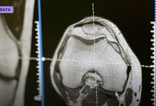 FDA-Cleared AI Tool Predicts Whether Breast Cancer Will Return Using Scans Patients Already Have