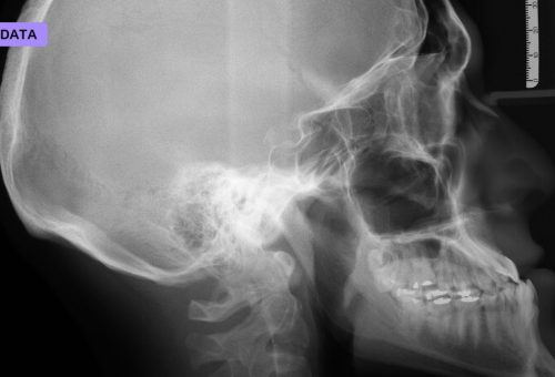 A Dallas Community Hospital Just Went Live With FDA-Cleared AI That Flags Brain Bleeds on CT Scans