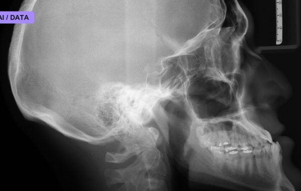 A Dallas Community Hospital Just Went Live With FDA-Cleared AI That Flags Brain Bleeds on CT Scans
